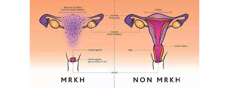子宫瘤切除后怀孕_输卵管狭窄,亮相：双鸭山卵巢早衰能借助试管婴儿技术助孕